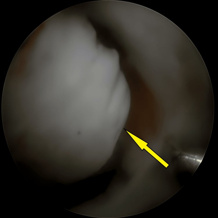 Initial arthroscopic view of a displaced tibial eminence fragment