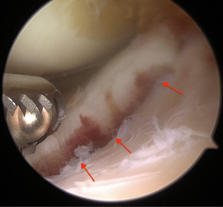 Arthroscopic view of an adult tibial-spine avulsion fragment