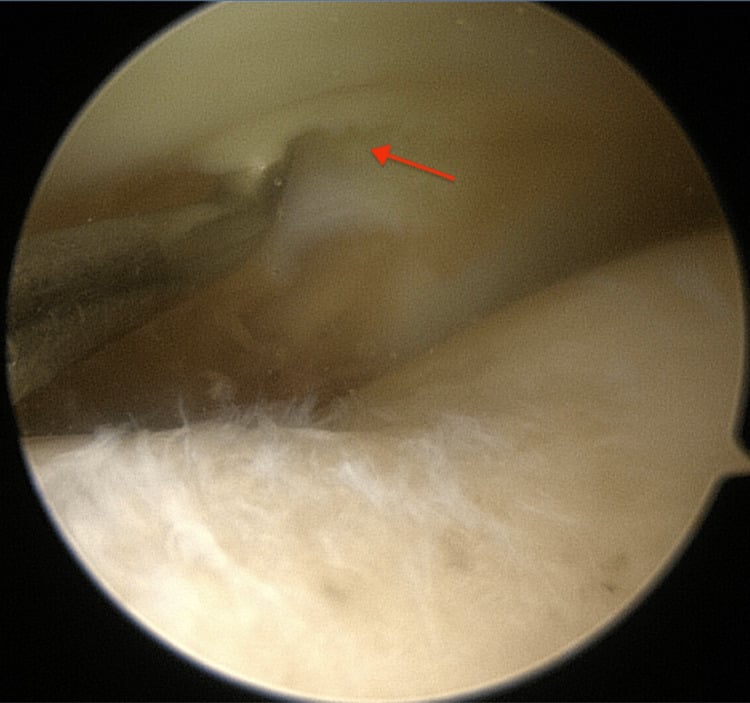 Arthroscopic horizontal medial-meniscus tear beneath a tibial eminence fragment