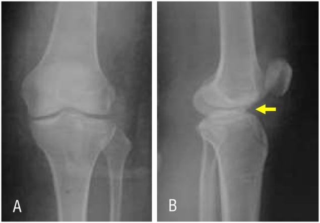 AP and lateral postoperative radiographs showing anatomic tibial-spine reduction