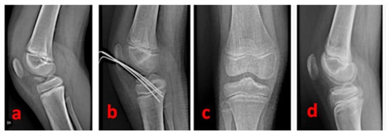 Type-III tibial-spine avulsion before K-wire fixation and after union