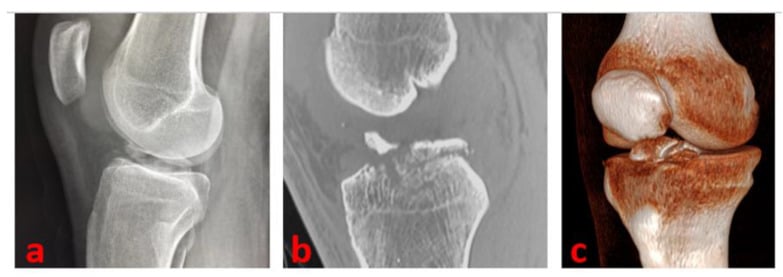 Lateral radiograph sagittal CT and three-dimensional CT of a type-III tibial-spine avulsion