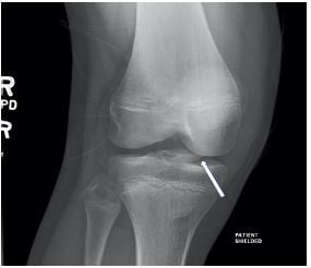AP radiograph of tibial spine avulsion fracture
