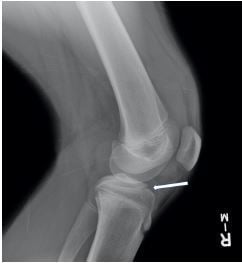 Lateral radiograph of tibial spine avulsion fracture