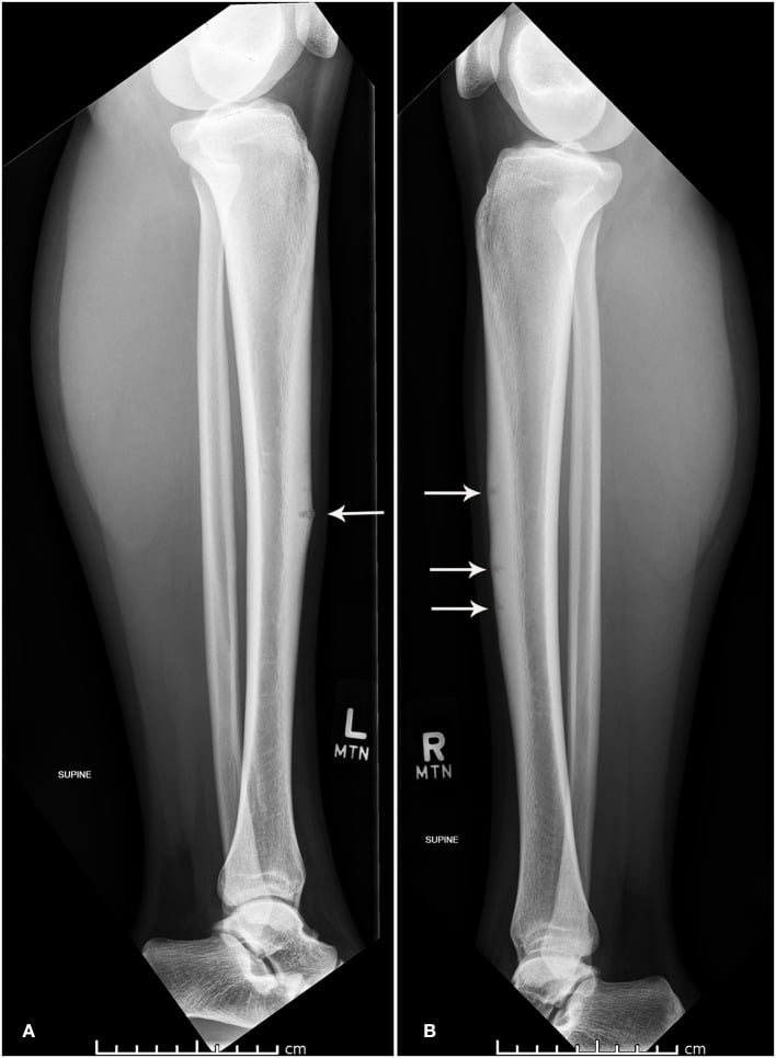 Lateral radiographs of the left and right tibiae with arrows on lucent lines in the anterior cortex, one on the left and three on the right