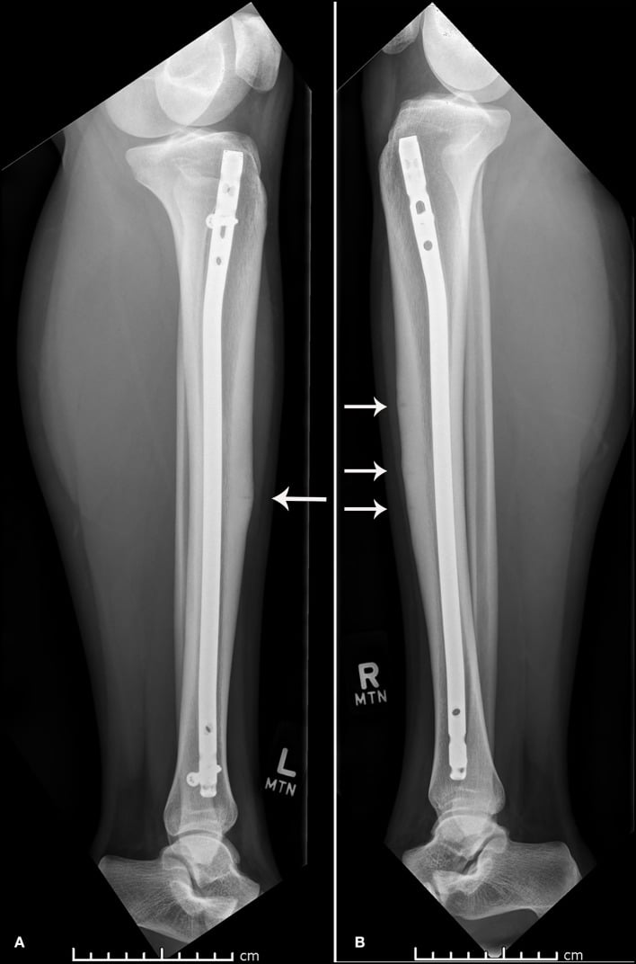 Lateral radiographs of both tibiae one year after intramedullary nailing, arrows at the levels of the anterior cortical stress-fracture lines