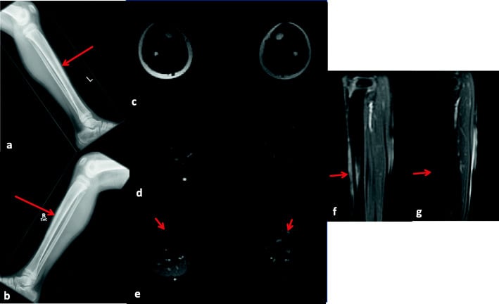 Radiographs of the left and right legs with arrows on the tibial shaft, and MRI of both legs with arrows marking signal change