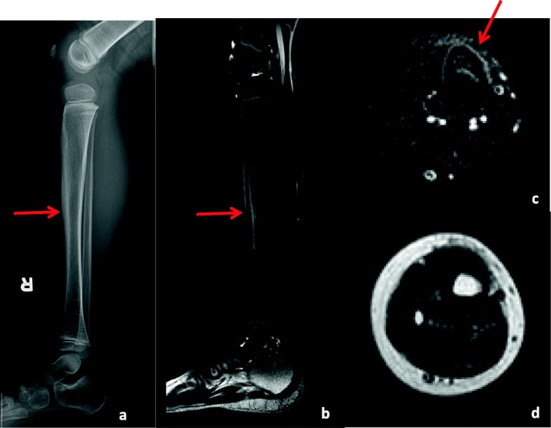 Radiograph and MRI of one leg with arrows marking a lesion in the tibial shaft