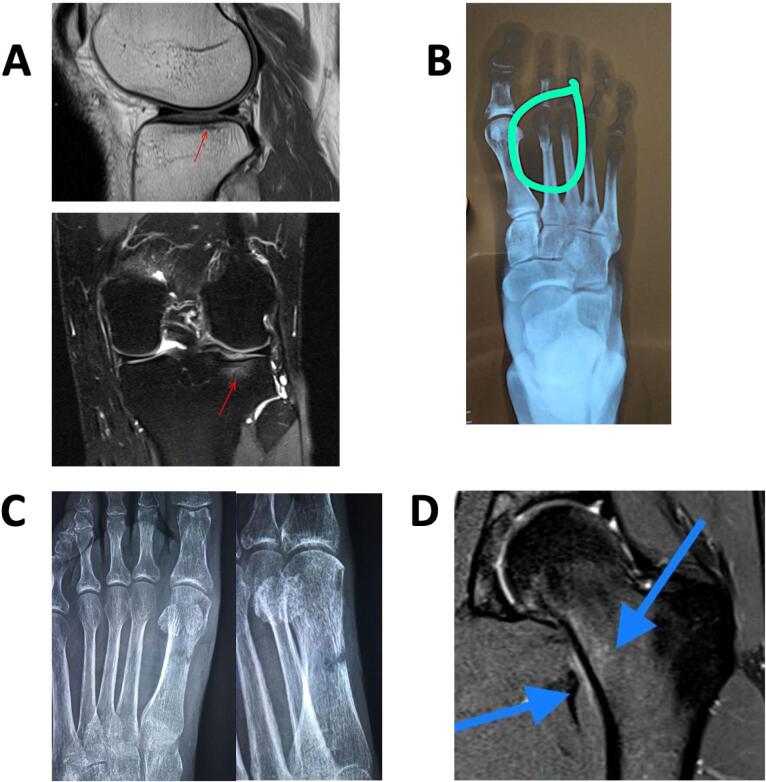 MRI and radiographs of stress injuries at several sites: proximal tibia, forefoot and femoral neck