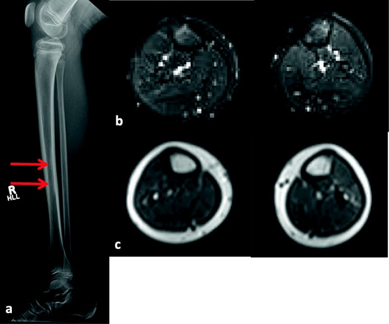 Tibial radiograph with two arrows on the shaft and two pairs of cross-sectional MRI images