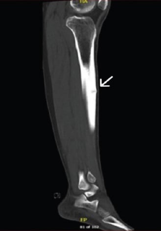 Sagittal CT scan demonstrating dreaded black line in anterior tibial stress fracture