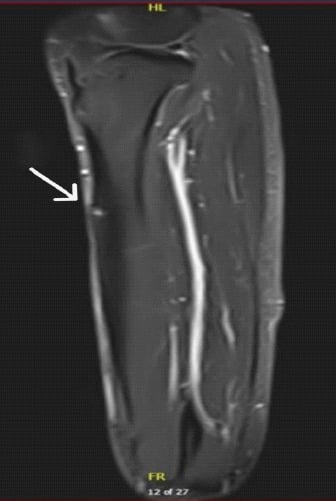 Sagittal T2 STIR MRI of tibia demonstrating endosteal marrow edema and stress fracture