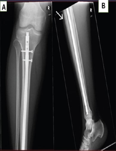Postoperative AP and lateral radiographs demonstrating IMN fixation of anterior tibial stress fracture
