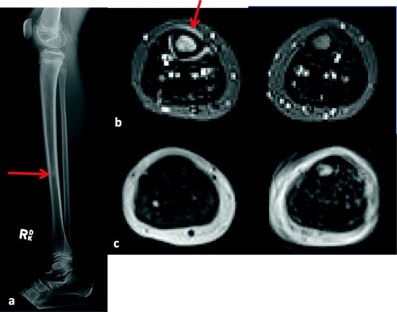 Tibial radiograph with an arrow on the shaft and two pairs of cross-sectional MRI images, one arrow on the tibial cortex