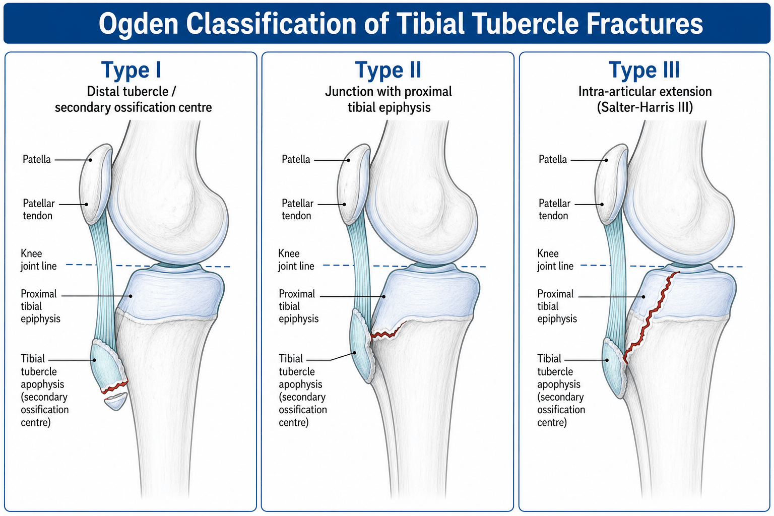 Ogden classification of tibial tubercle fractures