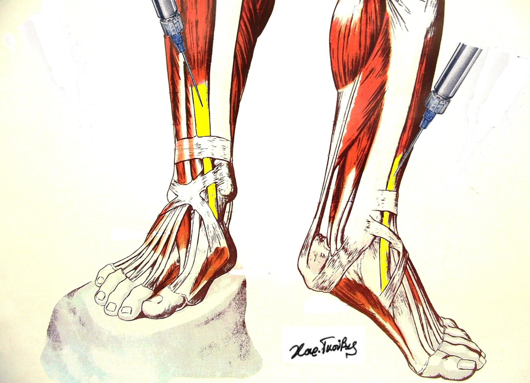 Anterior view of the leg showing tibialis anterior, the muscle immediately lateral to the tibial crest, with its tendon crossing the front of the ankle.