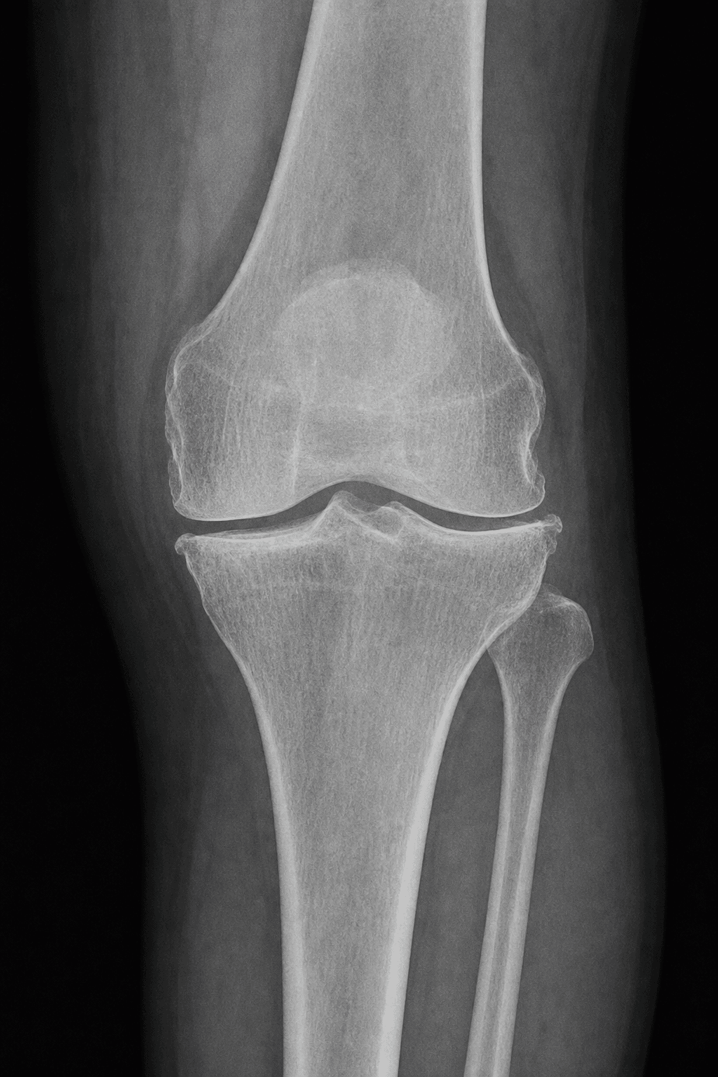 Standing AP knee radiograph showing medial-compartment osteoarthritis with varus alignment.