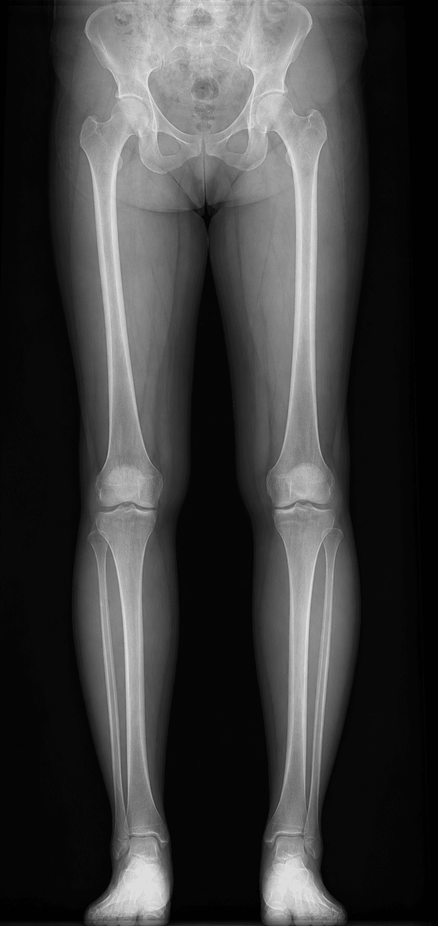 Full-length standing hip-to-ankle alignment radiograph of both lower limbs used to plan and measure knee alignment.