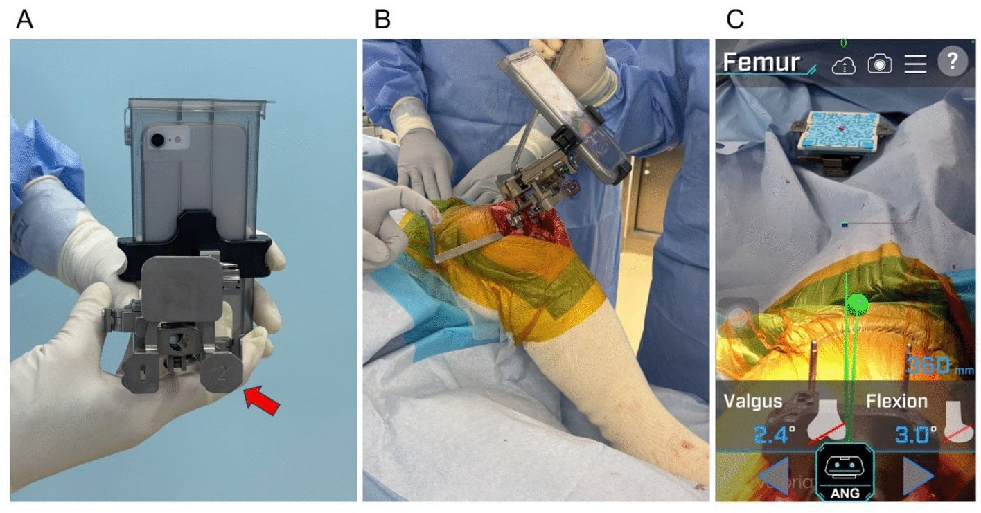 Calipered distal femoral resection with cartilage-loss compensation and real-time alignment display