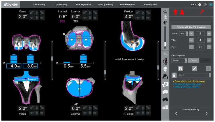 Robotic planning screen showing a functional-alignment TKA plan with adjusted femoral and tibial resections