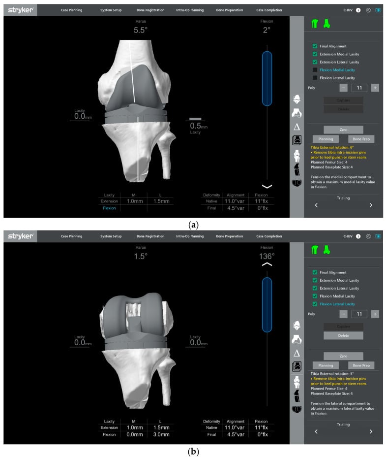 Robotic intraoperative gap assessment in full extension and ninety degrees of flexion