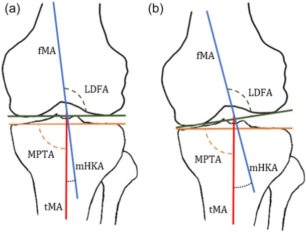 Knee schematics showing LDFA, MPTA and mechanical HKA geometry before and after coronal correction