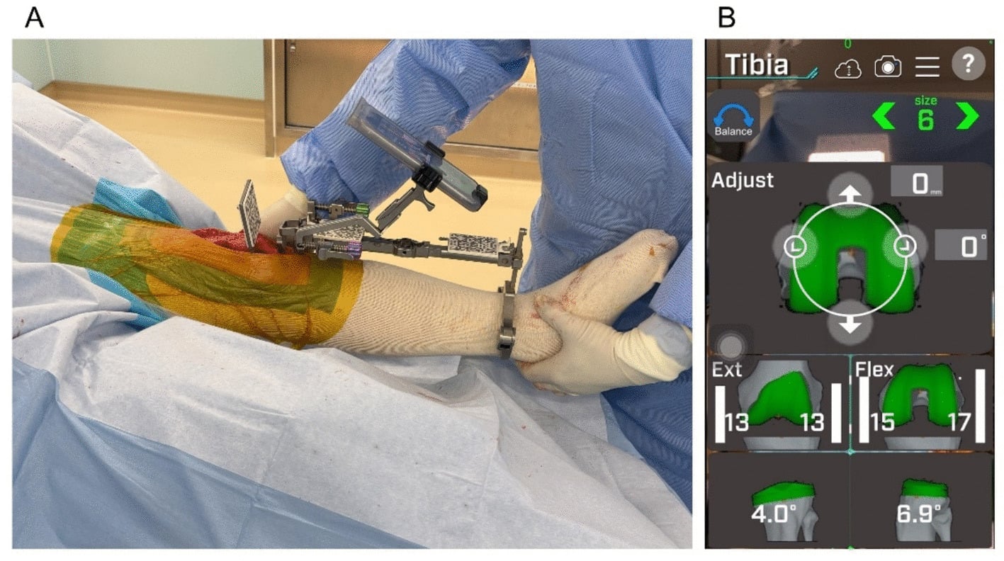Soft-tissue-guided proximal tibial resection with real-time extension-gap feedback