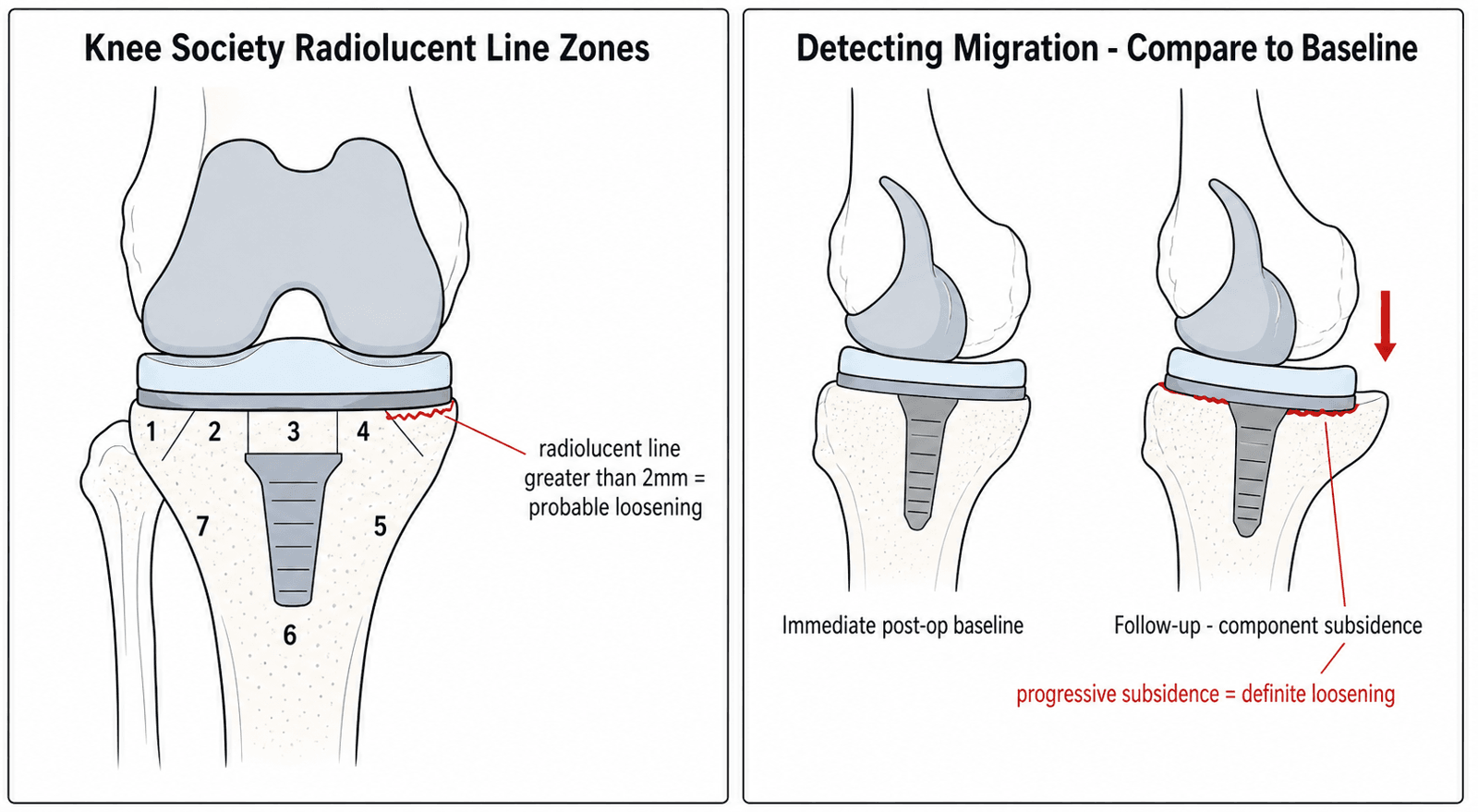 Two-panel schematic: the Knee Society radiolucent-line zone concept for the tibial component with an example radiolucent line, and a baseline-versus-follow-up comparison illustrating component subsidence.
