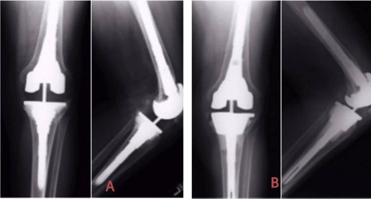 Radiographs of AORI type 3 tibial bone loss reconstructed with a metaphyseal cone