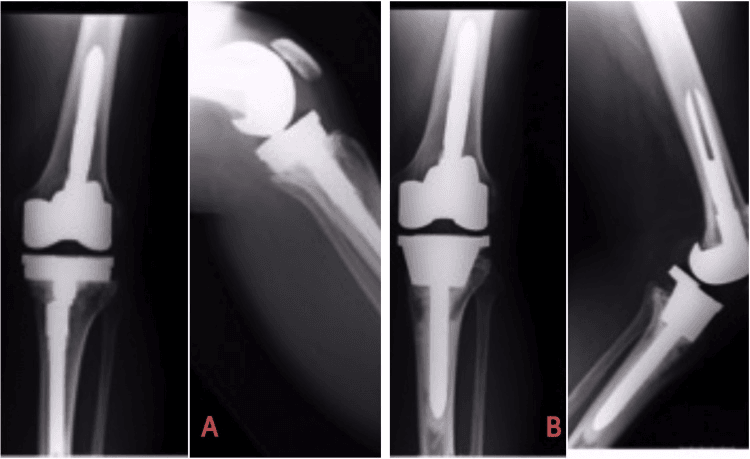 Loose augmented tibial component revised with metaphyseal cone fixation