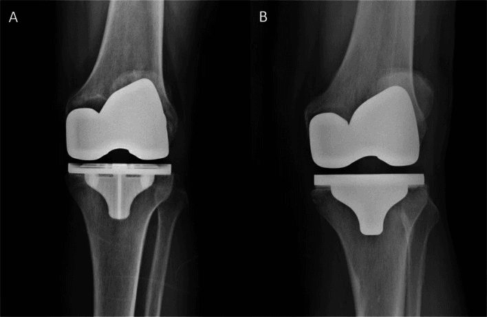 AP radiographs of two total knee arthroplasties with cementless and hybrid fixation
