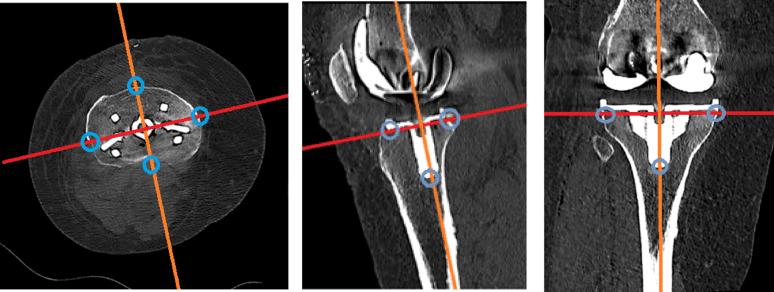 Multiplanar CT-RSA reference axes and peripheral tibial component points
