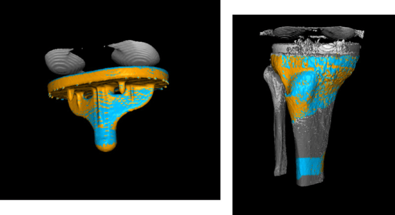 CT-RSA selective segmentation of tibial implant and bone
