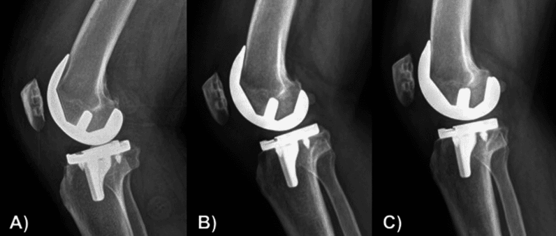 Serial radiographs showing early gap healing around a cementless tibial component