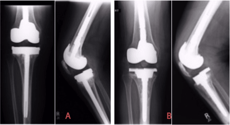 Tibial explant converting bone loss to AORI type 3 and subsequent cone reconstruction