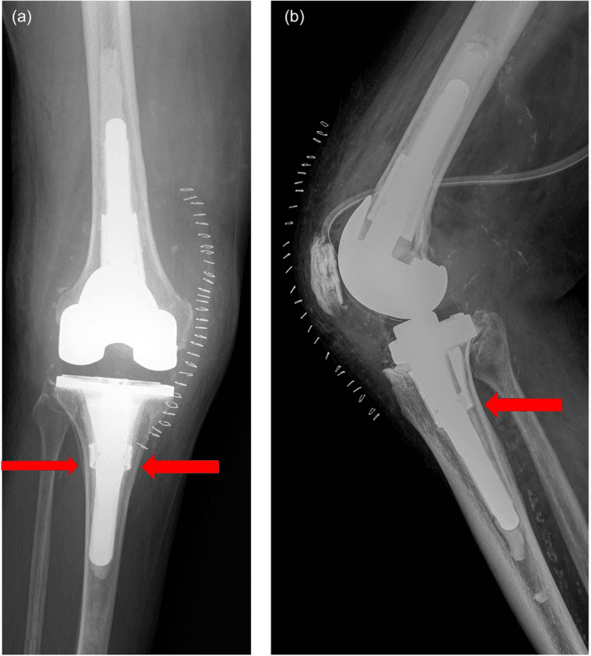 AP and lateral radiographs showing metaphyseal cone cortical impingement
