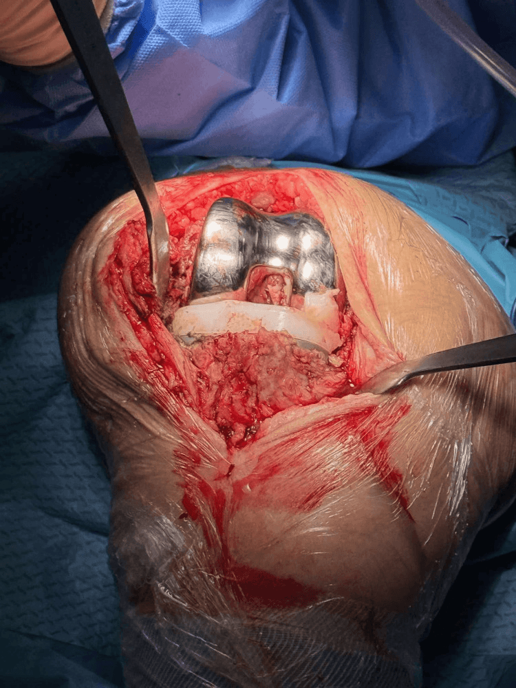 Intraoperative view of a torn polyethylene insert during revision TKA