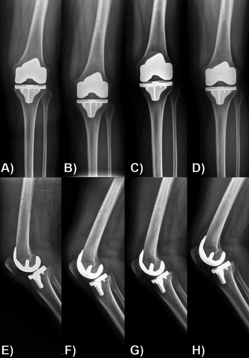 Serial AP and lateral radiographs showing progressive tibial baseplate subsidence