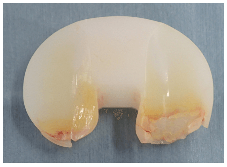 Retrieved TKA polyethylene insert showing severe wear and delamination