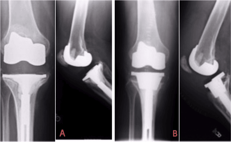 Preoperative loosening and five-year radiographs after metaphyseal cone revision