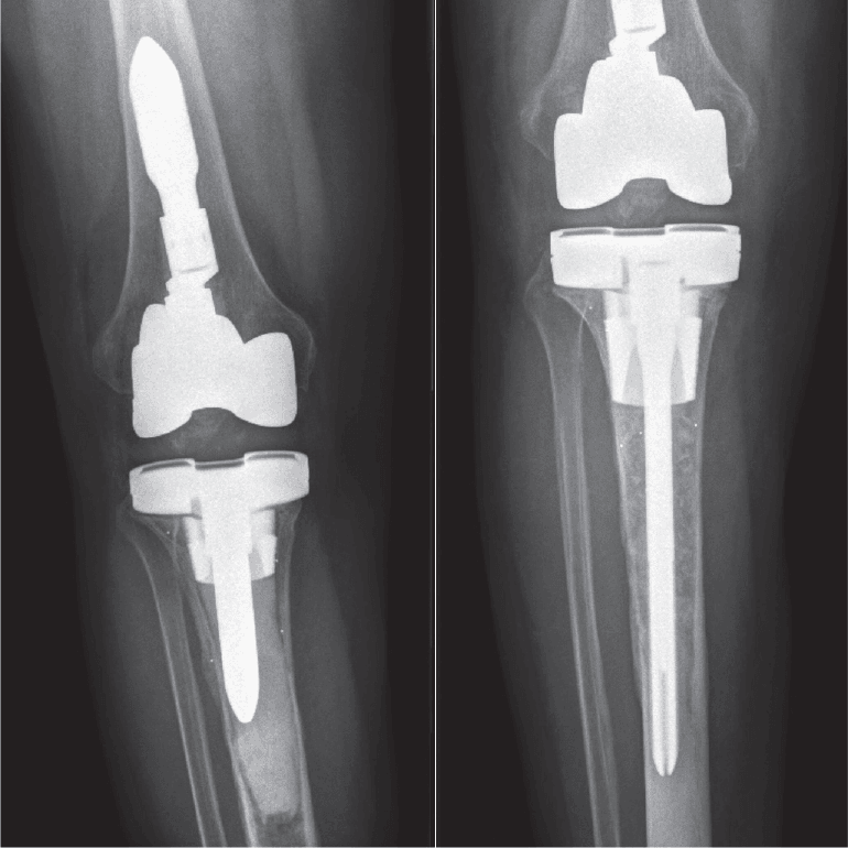 Radiographs before and after re-revision for RSA-confirmed tibial loosening