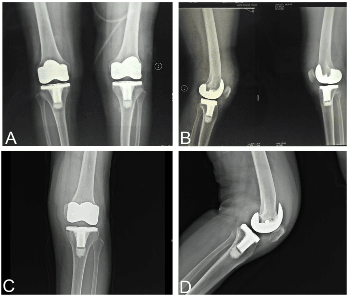 Serial AP and lateral radiographs from index TKA to symptomatic late loosening