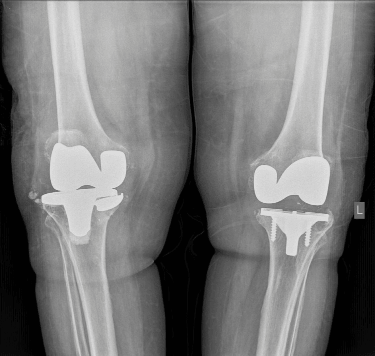 Radiographs showing tibial baseplate fracture with proximal tibial osteolysis