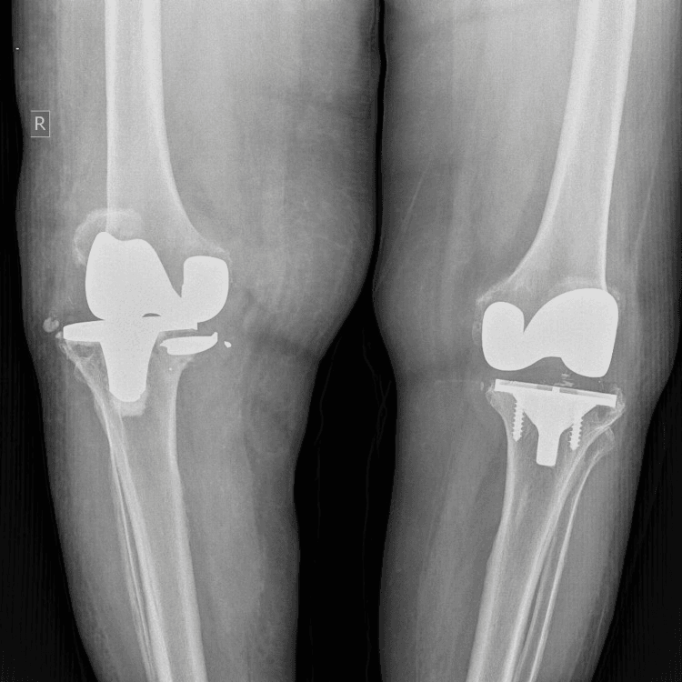 AP radiograph of both knees showing a fractured right tibial tray with a displaced segment