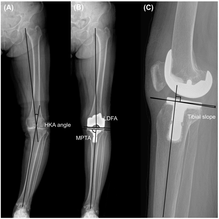 Standing long-leg and lateral TKA radiographs showing HKA alignment, component angles and posterior tibial slope