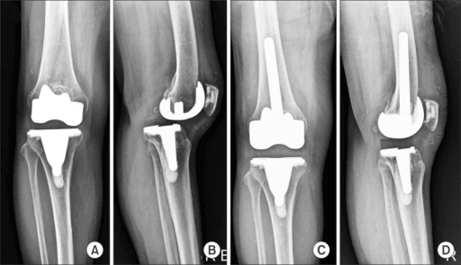 CR TKA instability converted to posterior-stabilized TKA