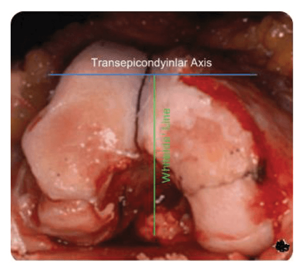 Intraoperative distal femur with the transepicondylar axis and Whiteside line marked for femoral component rotation
