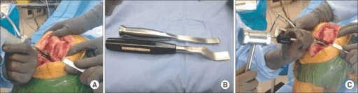 Posterior compartment osteophyte access in TKA gap balancing