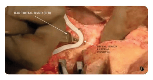 Intraoperative iliotibial-band pie-crusting during valgus total knee arthroplasty