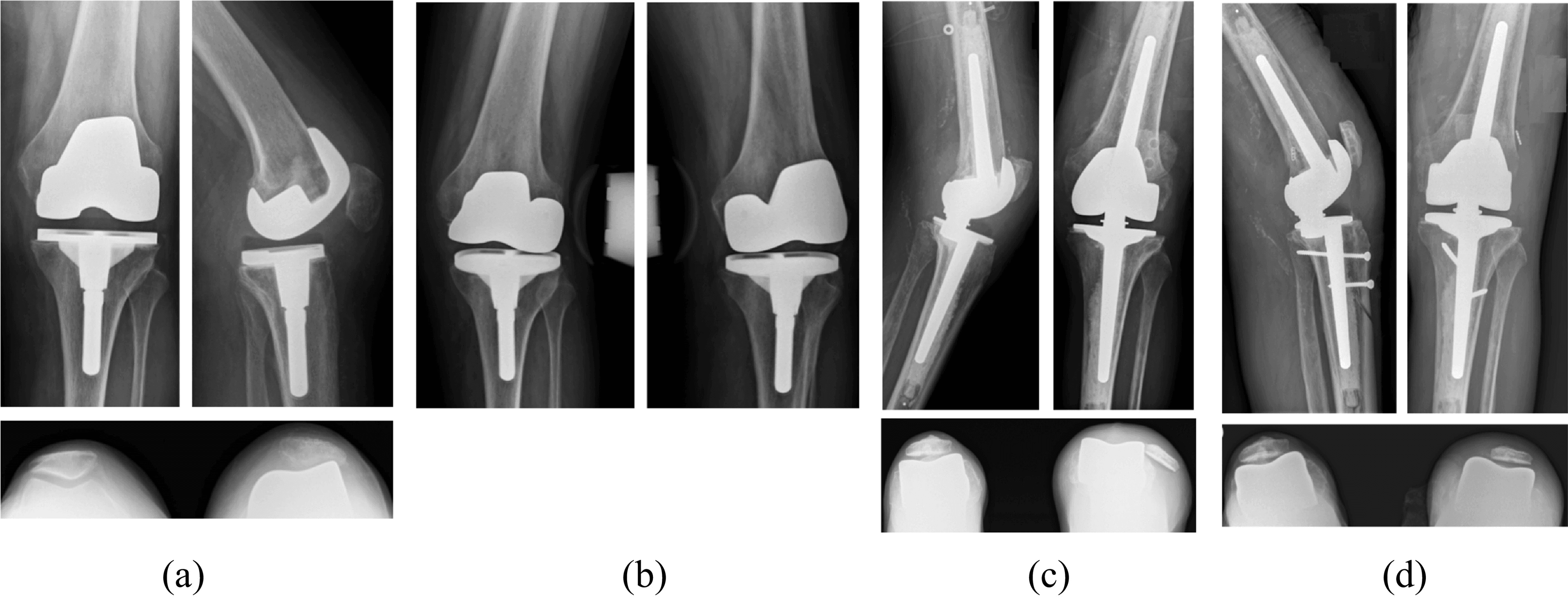 Serial radiographs of recurrent TKA instability treated with rotating-hinge revision and subsequent patellar stabilisation